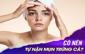 5 Sai Lầm Cực Lớn Khi Tự Trị Mụn Tại Nhà