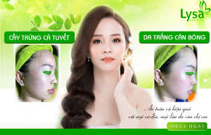 Cấy Trứng Cá Tuyết – Da Trắng Căng Bóng